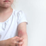 neurodermatitis