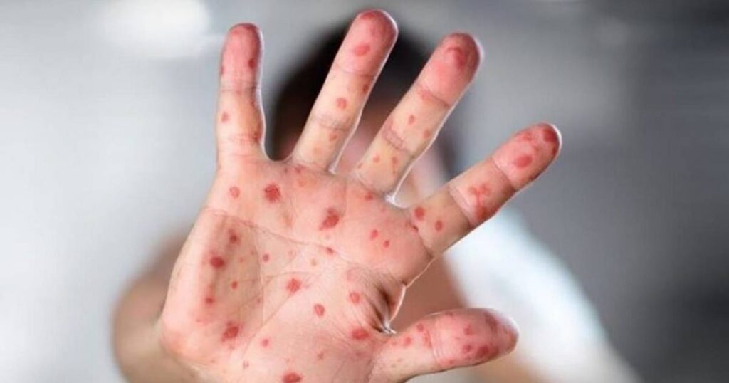 Kantonalna vlada upozorava: Pojavile se morbile, građani se pozivaju na odgovornost