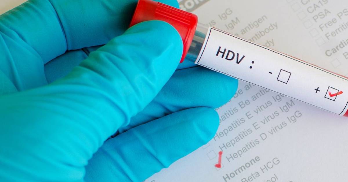 hepatitis