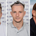 ivan rakitic Transplantacija kose