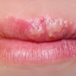 herpes