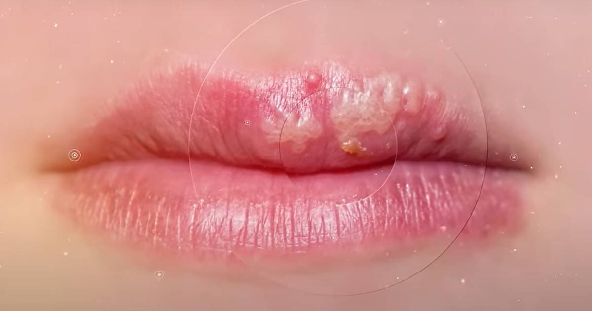 herpes