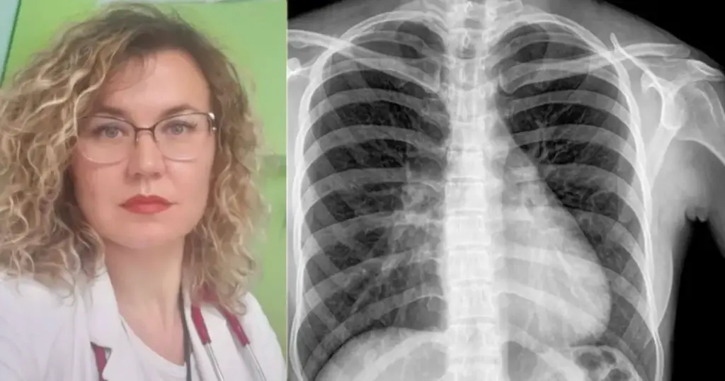 Danina Dohranović-Tafro tuberkuloza