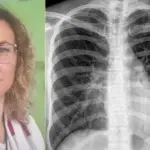 Danina Dohranović-Tafro tuberkuloza