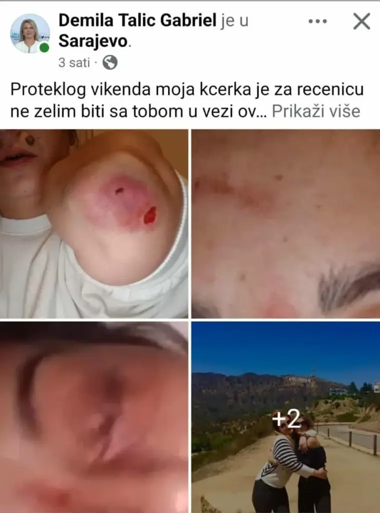 Kćerku bivše konzulice BiH brutalno pretukao dečko