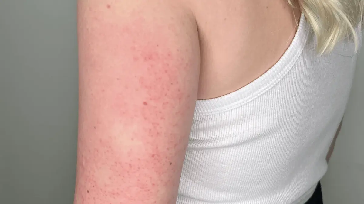 Kako se riješiti “pileće kože”, problema koji pogađa svaku drugu osobu