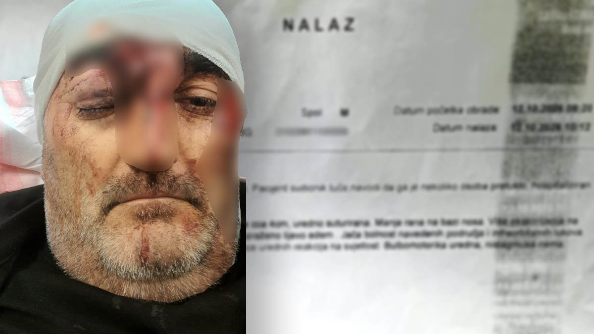 Pretučen nakon lovačkog druženja: “Ja završio u bolnici, oni nastavili jesti i piti”