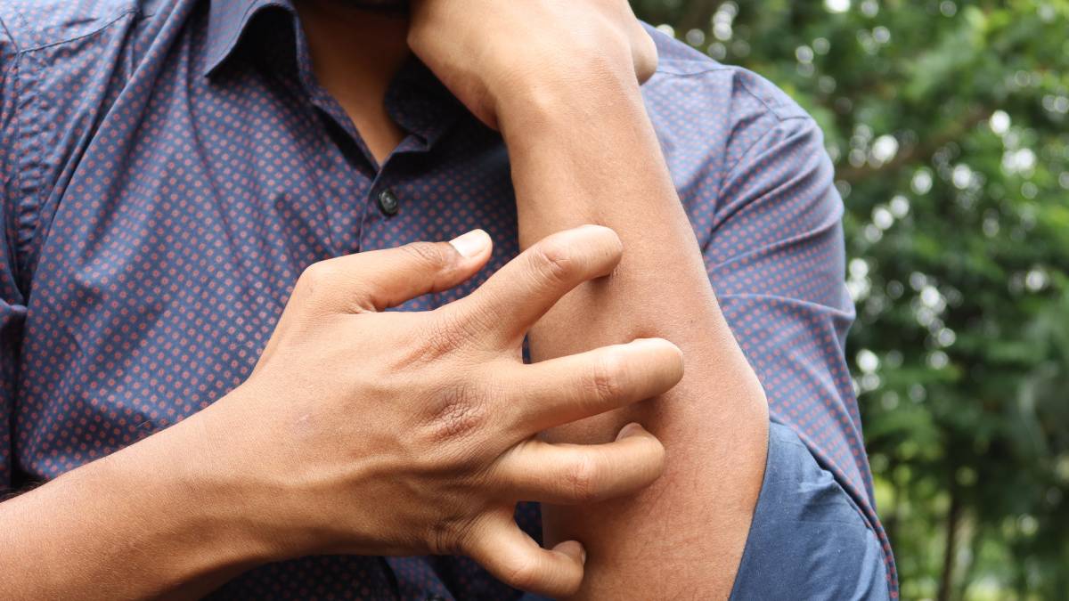 Psorijaza nije samo estetski problem: Kako je prepoznati i kada otići ljekaru